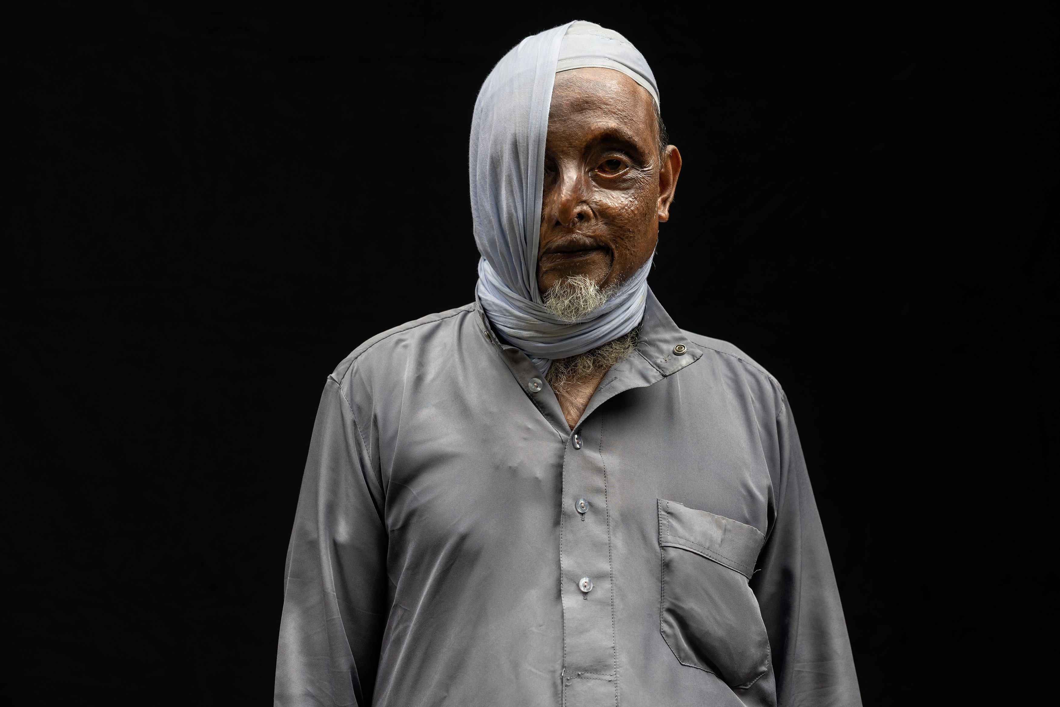 Acid attack Survivors
